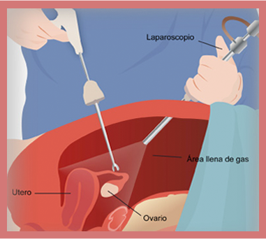 laparoscopy hospital in Delhi