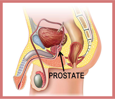 prostate stone removal surgery