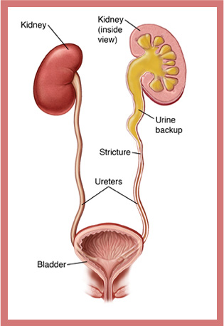 Urethral Stricture