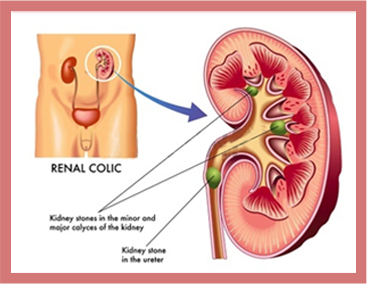 Urinary Stones Treatment in Delhi